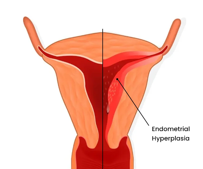 endometrial hyperplasia